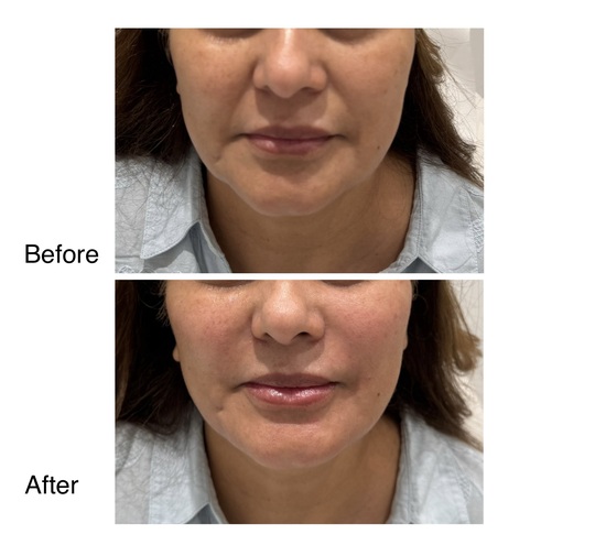 Before and after radiesse · facial rejuvenation from Dr. Zaheer Abbas’s procedure gallery