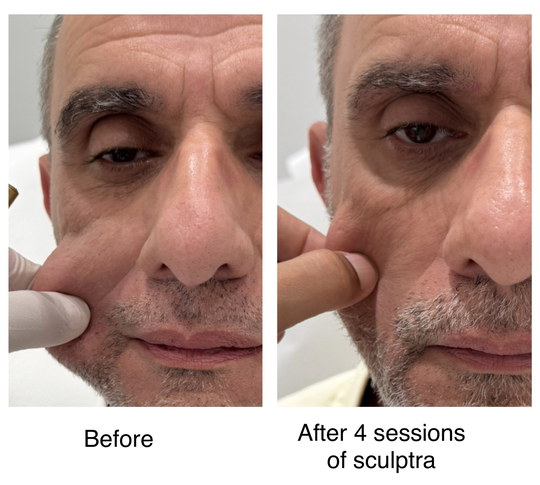 Before and after sculptra · skin quality from Dr. Zaheer Abbas’s procedure gallery