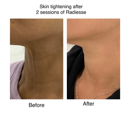Before and after radiesse · neck treatment from Dr. Zaheer Abbas’s procedure gallery