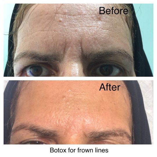 Before and after expression lines from Dr. Zaheer Abbas’s procedure gallery