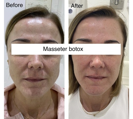 Before and after masseter treatment from Dr. Zaheer Abbas’s procedure gallery