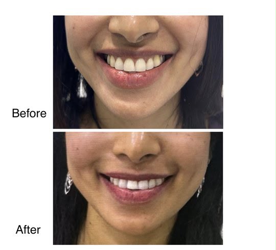 Before and after gummy smile & nose tip from Dr. Zaheer Abbas’s procedure gallery