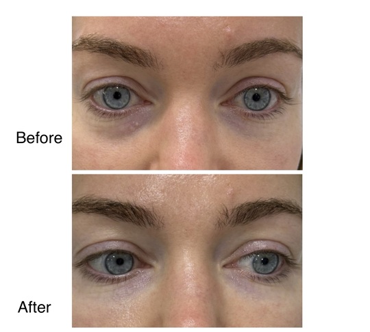 Before and after under eye treatment from Dr. Zaheer Abbas’s procedure gallery