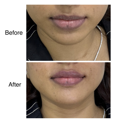 Before and after lip enhancement from Dr. Zaheer Abbas’s procedure gallery