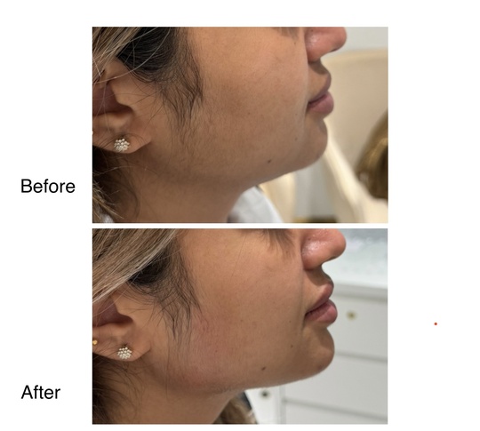 Before and after jawline definition from Dr. Zaheer Abbas’s procedure gallery